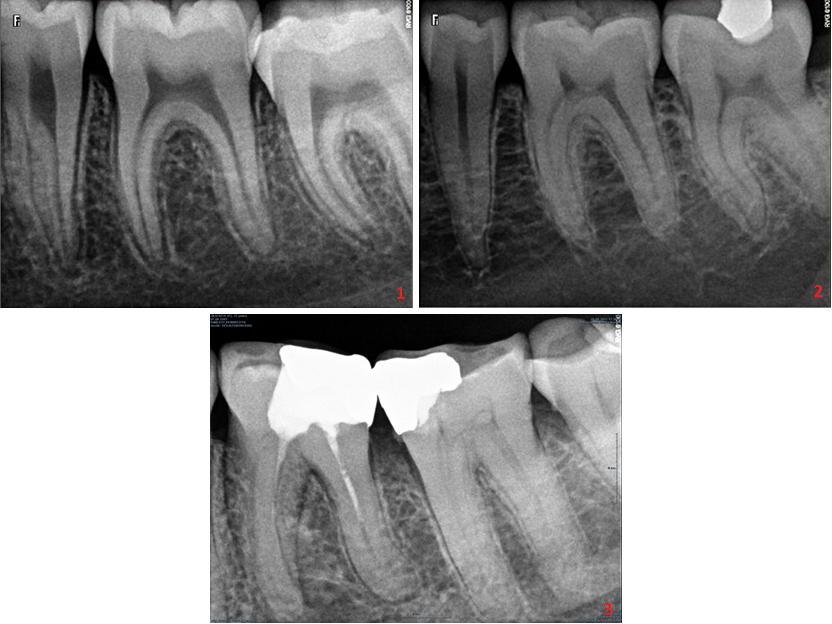 Röntgenülesvõtted on tehtud erinevas vanuses naispatsientide sama piirkonna hammastest. Esimesel pildil keskosas on 12-aastase naispatsiendi alumine vasakpoolne purihammas (D36), teisel pildil keskel 25-aastase naispatsiendi samanimeline hammas (D36). Näha on, et täiesti tervete purihammaste pulbiruumid on juba pisut erinevad - vanemal patsiendil on pulbiruum veidi ahenenud. Kolmandal pildil aga on 72-aastase naispatsiendi alumised vasakpoolsed purihambad (D36 ja 37), milledel on näha juba parempoolsel purihambal (D37) tugev pulbiruumi ahenemine. Tegu on füsioloogilise ahenemisega ning tegu pole patoloogiaga.