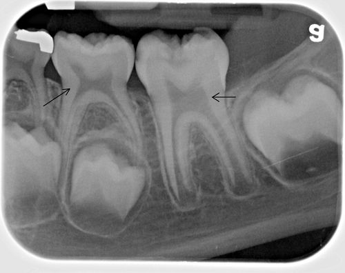 Allikas: [val=http://rickwilsondmd.typepad.com/rick_wilson_dmds_blog/2011/01/dental-pulp-calcification-and-changes-with-age.html href=http://rickwilsondmd.typepad.com/rick_wilson_dmds_blog/2011/01/dental-pulp-calcification-and-changes-with-age.html]