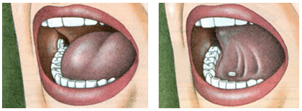 Joonis 3. Ravimi asukoht suhu manustamisel: vasakul - põske ehk bukaalne manustamine; paremal - keele alla ehk sublingvaalne manustamine.
Allikas: Lippincott Williams & Wilkins (2009). Lippincott's nursing procedures. 5th ed. Philadelphia.