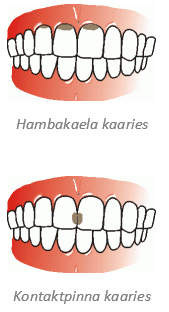 Kaaries