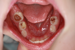 Dentiinikaaries